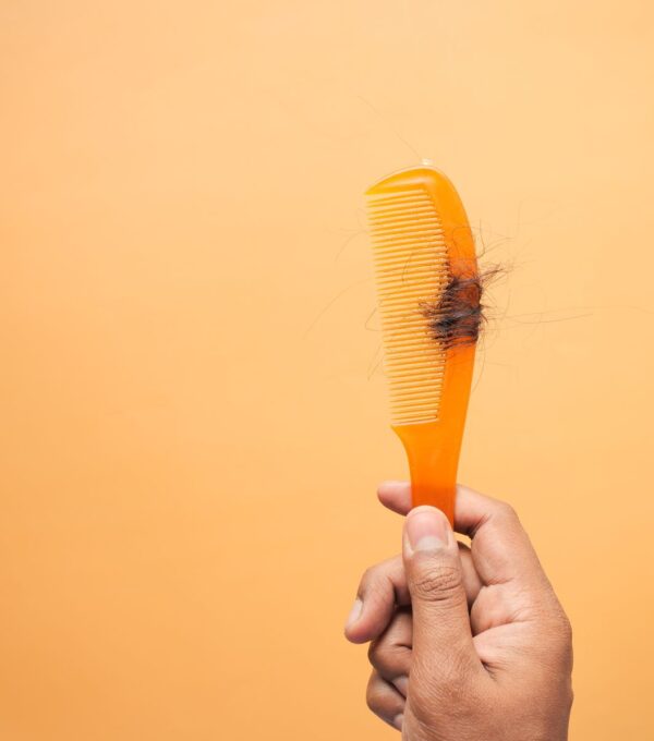 Hair strands on a comb illustrating temporary shock loss after a hair transplant